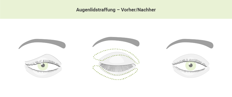 Augenlidstraffung in der Sophienklinik Stuttgart – Vorher und nachher