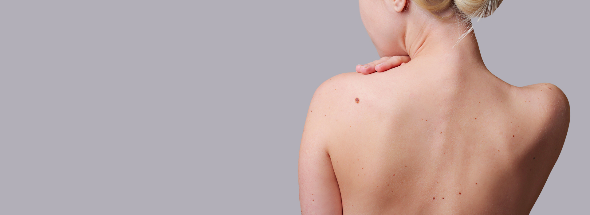 Skin cancer screening / birthmarks