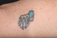Bildaufnahme vor einer Tattooenterfernung
